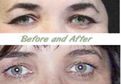 AGING CHANGES IN THE EYE AREA
